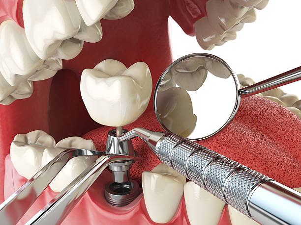 Best Emergency Broken Tooth Repair in Cherry Valley, IL